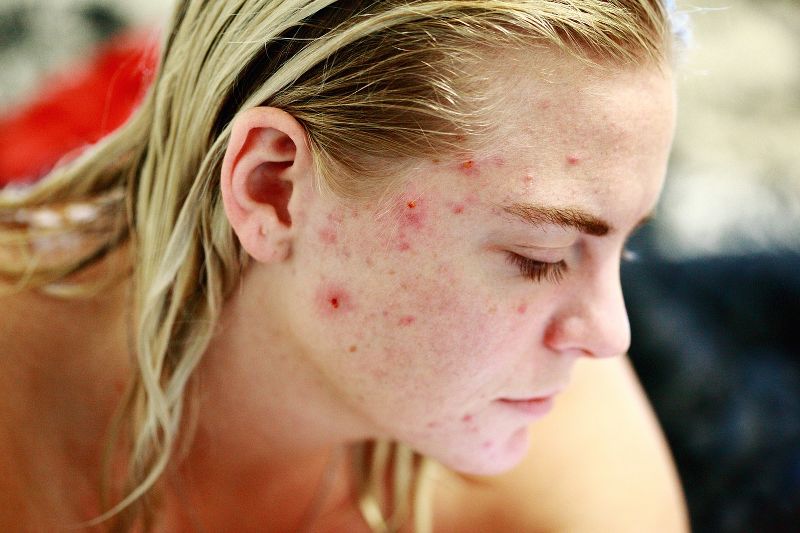 Vediamo come il tea tree oil si può usare sui brufoli sottopelle e per l’acne