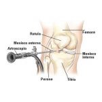 artroscopia ginocchio