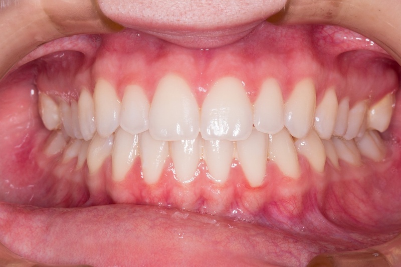 Come riusciamo a diagnosticare correttamente una parodontite?